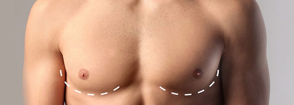 Jinekomasti header